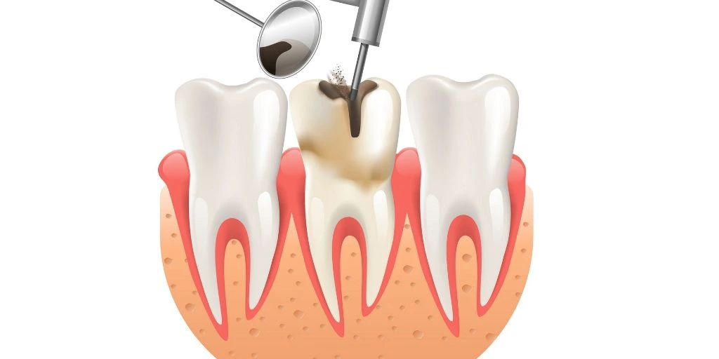 عصب کشی دندان گرگان 7840343015