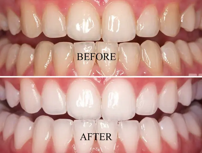 قبل و بعد از بلیچینگ دندان در گرگان 251465454685431