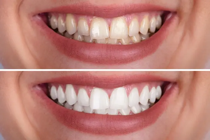 سفید شدن دندان ها با بلیچینگ دندان 3216478746544502