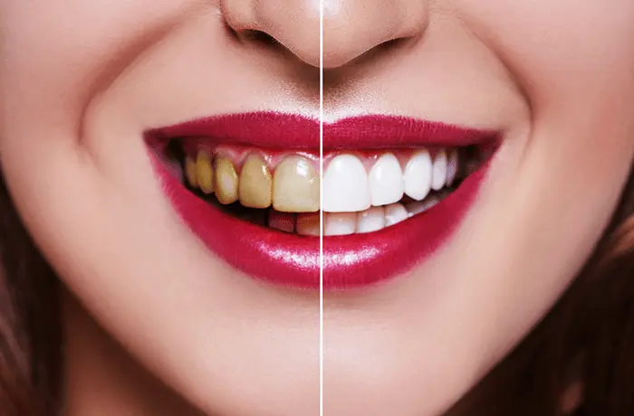 بلیچینگ دندان روشی برای زیباسازی طرح لبخند 65454684565612