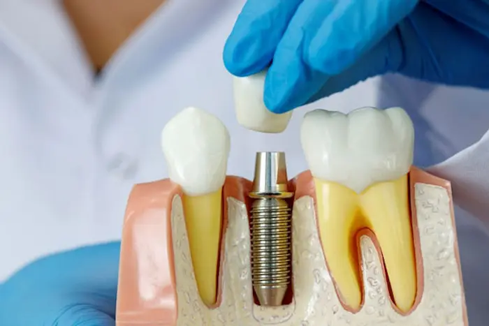 تفاوت ایمپلنت دندان و روکش دندان 874654658465451