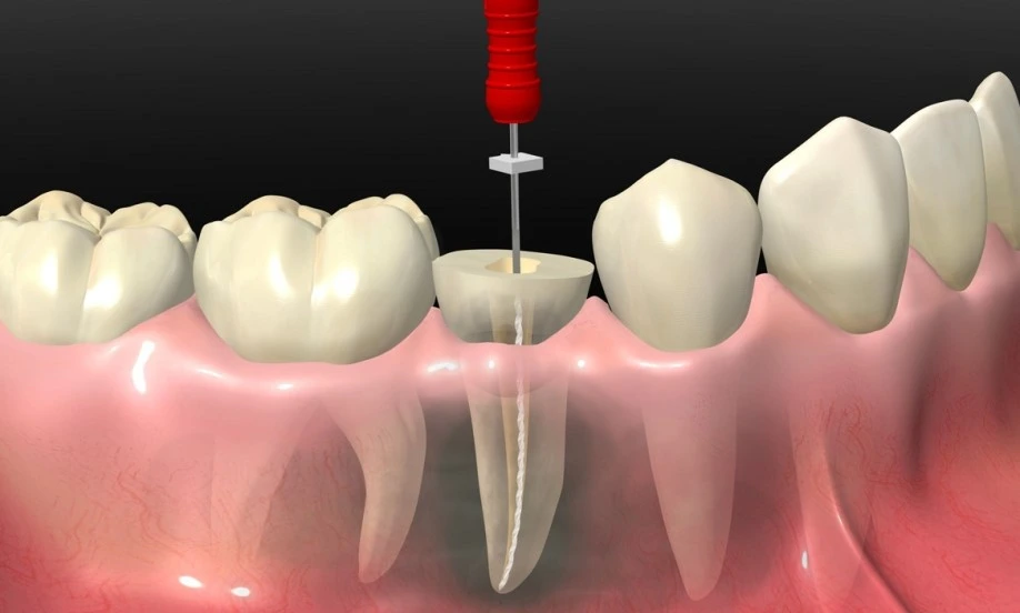 عصب کشی دندان گرگان 147342010356