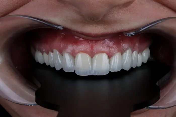 تفاوت ایمپلنت دندان و روکش دندان 8745654561215