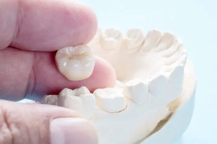تفاوت ایمپلنت دندان و روکش دندان 68454541351210