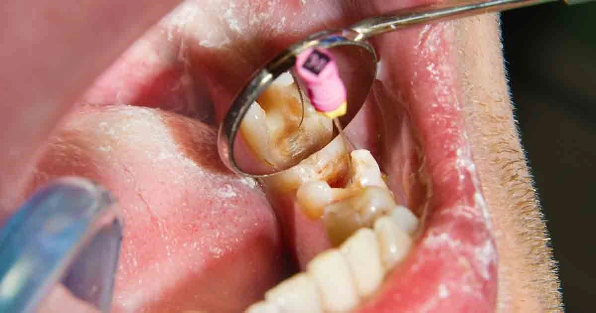 عصب کشی دندان گرگان 47564657421230