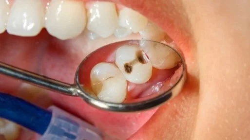 ترمیم دندان در گرگان 455521031200