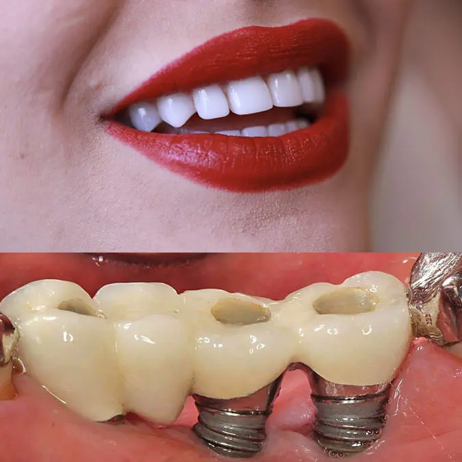 ایمپلنت دندان و زیبایی لبخند بانو و روکش دندان با پایه مستحکم در فک پایین 52452842468