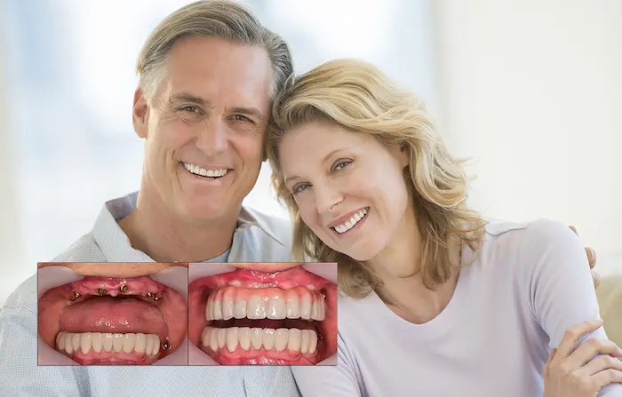 روکش دندان در بزرگسالان با پیاده سازی بهترین روش 425452455