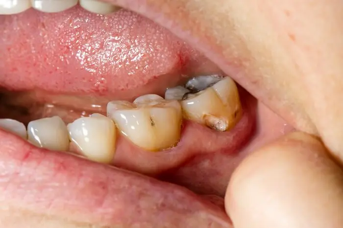 عفونت دندان بر اثر عوض شدن رنگ دندان 1563263232