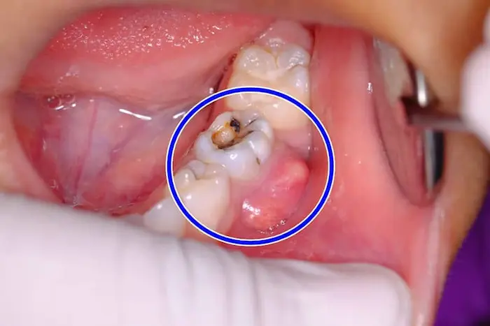 عفونت دندان در اثر پوسیدگی 562626326312