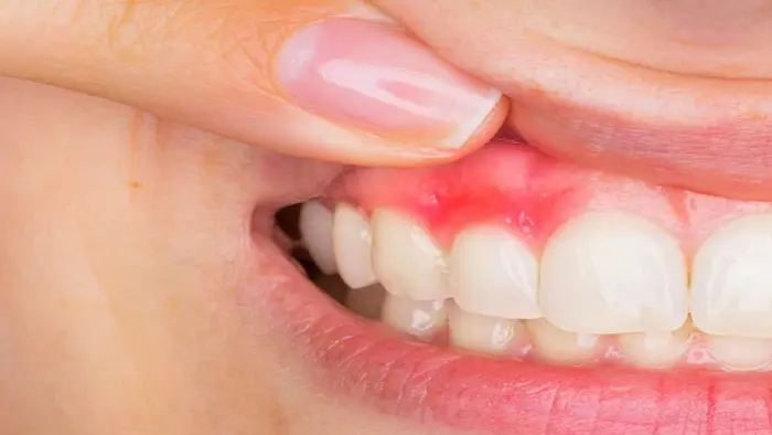 کیست دندان و لثه بر اثر عفونت 1521263526325