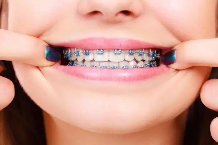 ارتودنسی کامل تمام دندان ها 2163216321321