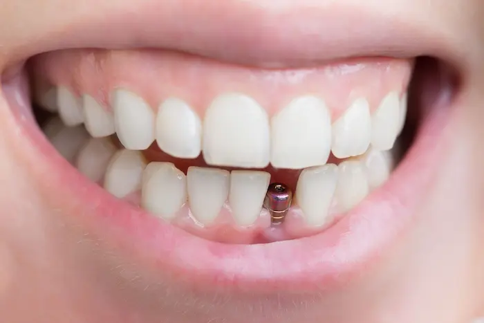 ایمپلنت دندان جلویی 15146216