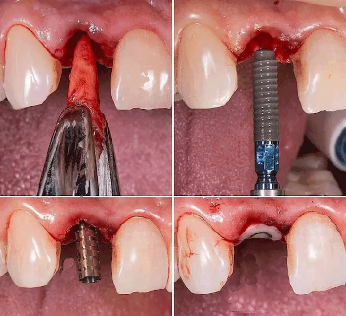 مراحل انجام کاشت ایمپلنت دندان فوری 12562641641