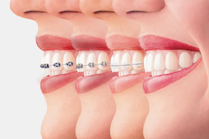 مراحل انجام ارتودنسی دندان 14564156126312