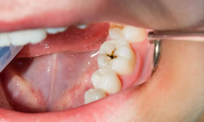 دندانی که دچار پوسیدگی شده 6787887878