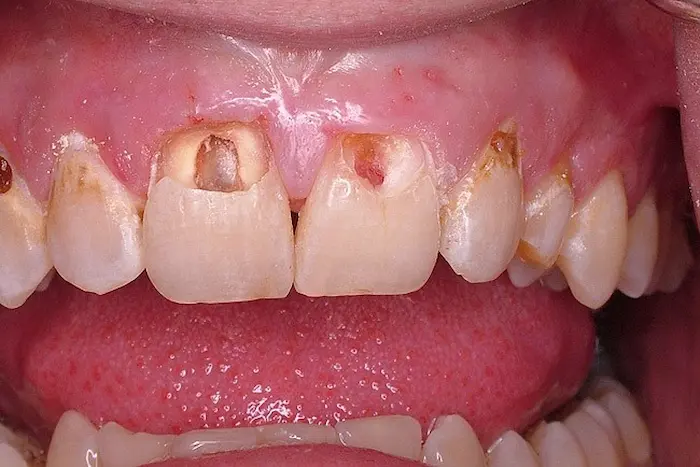 پوسیدگی پالپ یا ریشه دندان 56657888
