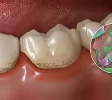 پلاک دندان 5425454152