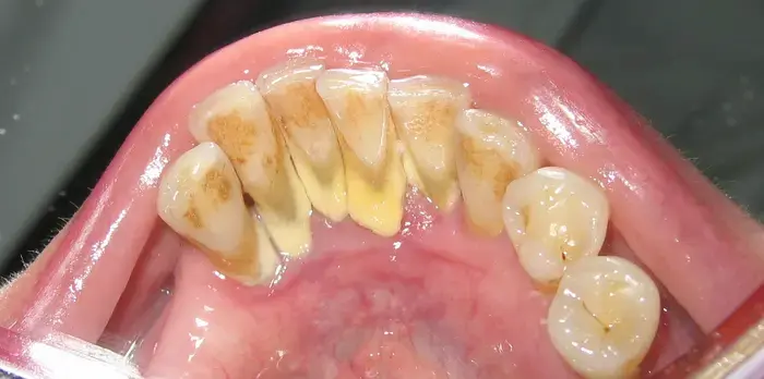پلاک دندان 4545245