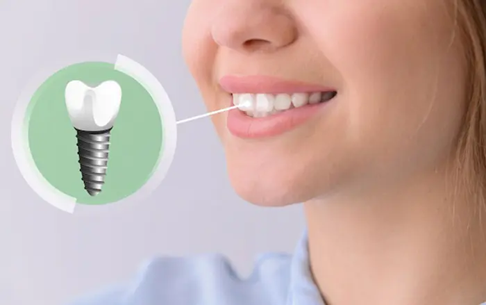زیباسازی دندان های جلویی با ایمپلنت دندان 326841351