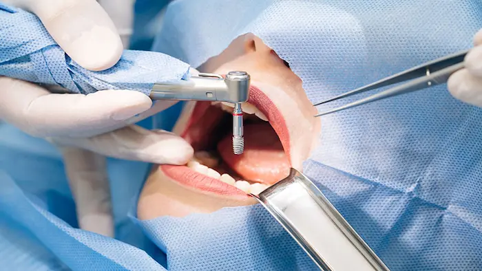 جراحی ایمپلنت دندان در کلینیک تخصصی دندانپزشکی گرگان 21584154120