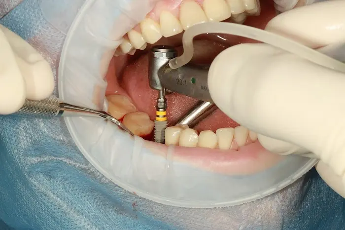 جراحی کاشت ایمپلنت دندان با ابزار پیشرفته در گرگان 13544504