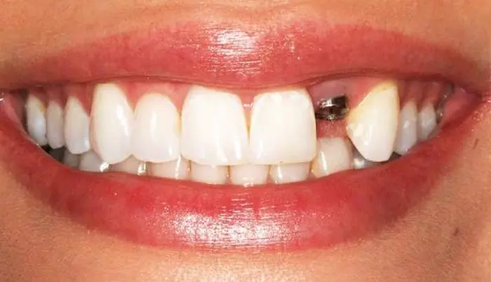 عکس بیمار مبتلا به عفونت ایمپلنت دندان 1536465484