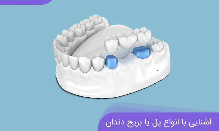 نمایش دادن انیمیشن بریج دندان 21546748784