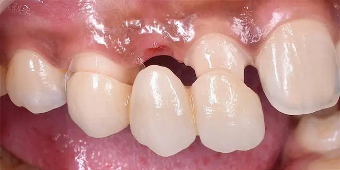 گذاشتن پل دندان در دهان بیمار 456768744