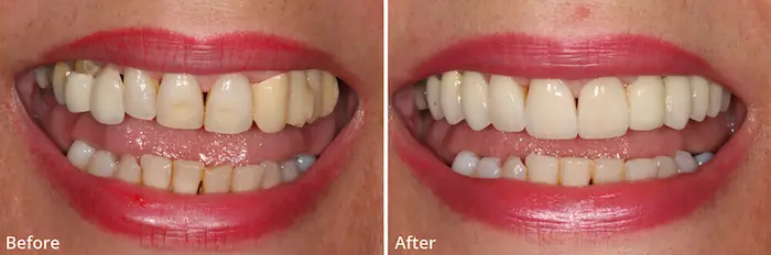 قبل و بعد بریج دندان بیمار 486746486777