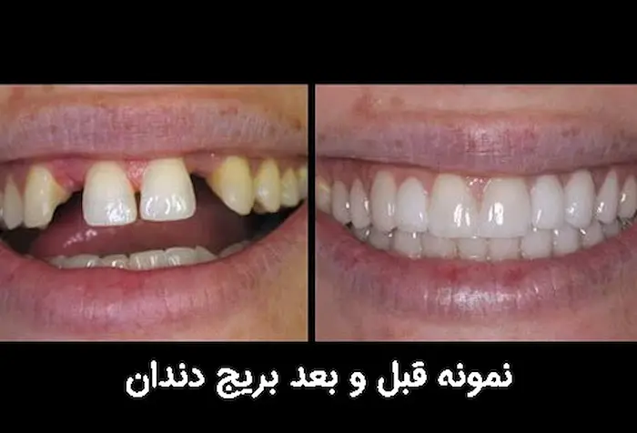 قبل و بعد بریج کردن دندان 54476687474