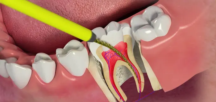 نمایش نحوه کشیدن عصب کشی دندان 657465489777