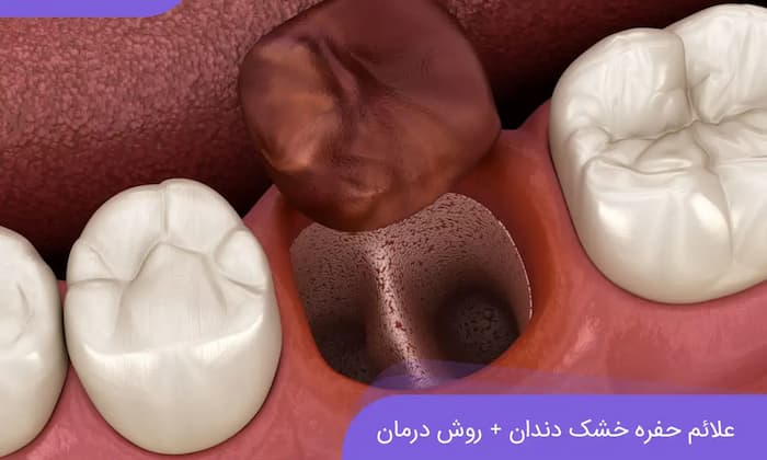 به نمایش گذاشتن انیمیشن حفره خشک دهان 1536469788774