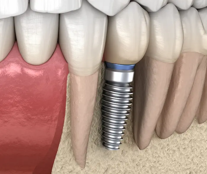 تصویر انیمیشنی از ایمپلنت دندان در فک پایین 4168974
