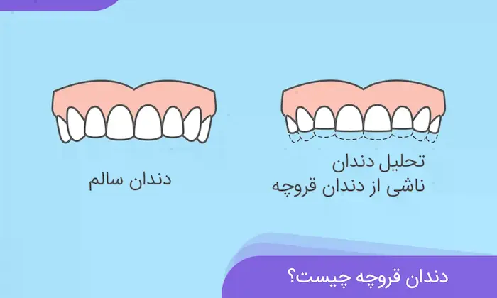 فرق بین دندان های سالم و ساییده شده در دندان قروچه 798978