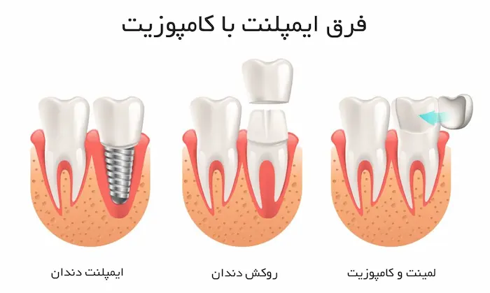 فرق ایمپلنت با کامپوزیت در تصویر نوشته شده است 4869768