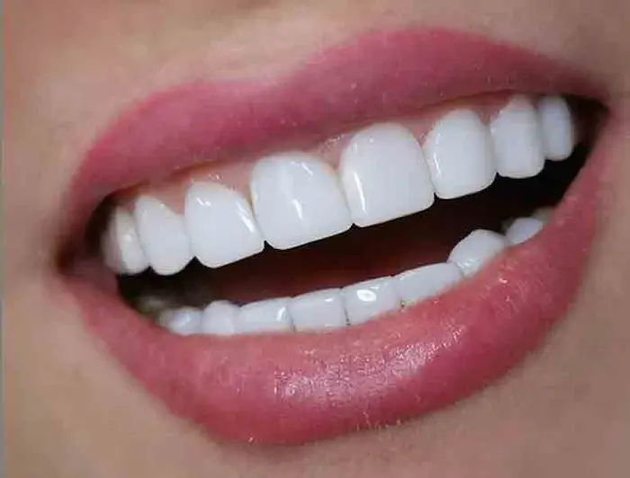 سفیدی دندان فک بالا و پایین دندان ها با کامپوزیت 468748
