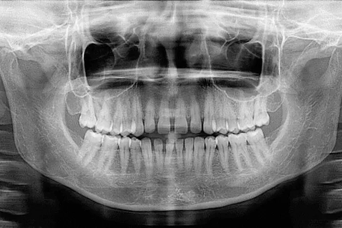 عکس رادیوگرافی دندان 468746