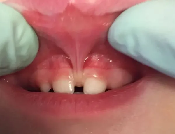 فاصله بین دندانی و برجسته بودن فرنوم بالا در کودک بیمار 486674687