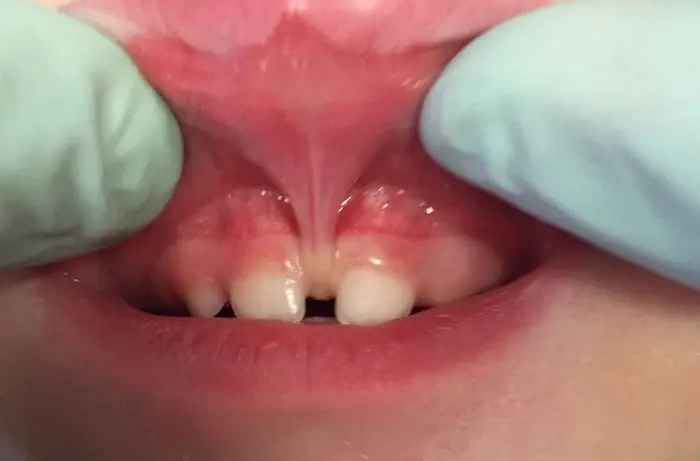 فاصله بین دندانی و برجسته بودن فرنوم بالا در کودک بیمار 486674687