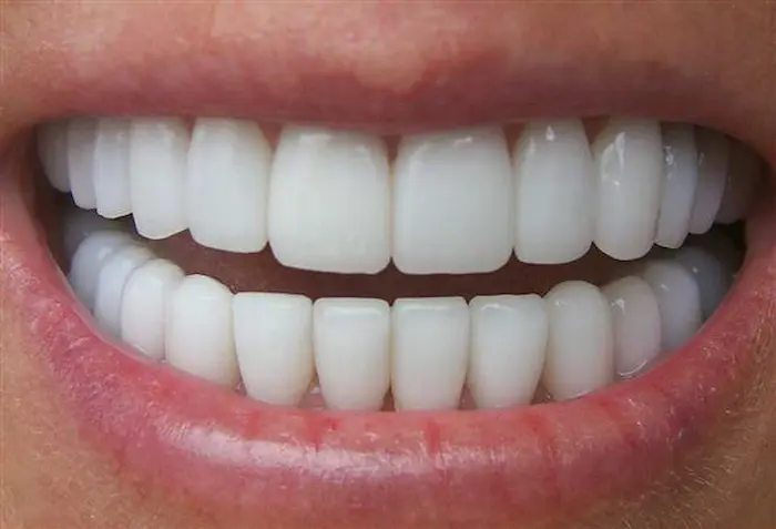 مرتب و سفید بودن دندان با کامپوزیت و لمینت 48786
