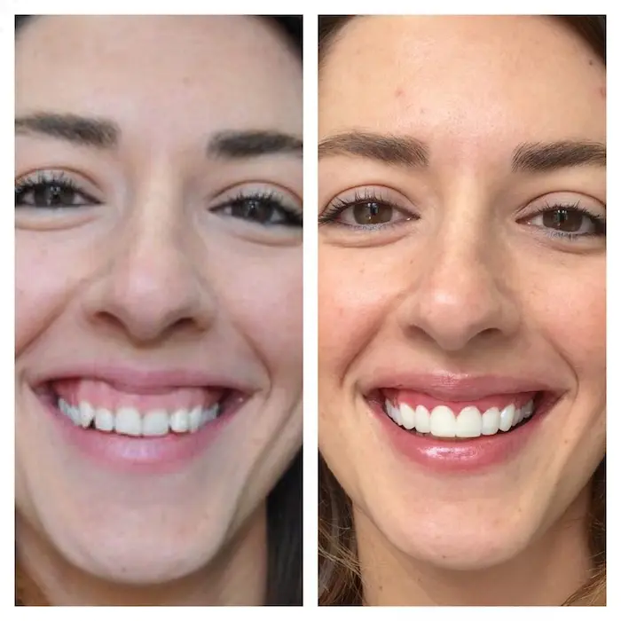 ارتودنسی متحرک قبل و بعد انجام ان بر روی دندان های خانم 4854
