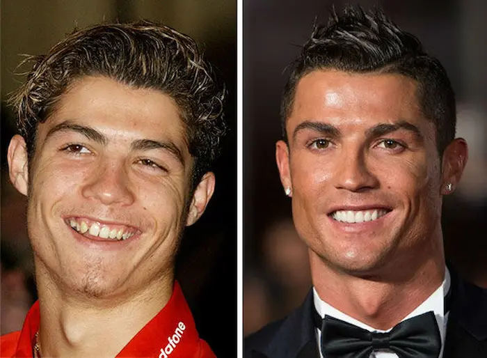 عکس قبل و بعد ارتودنسی متحرک رونالدو، بازیکن مشهور فوتبال 54654