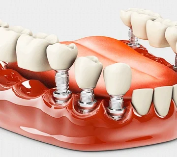 پروتز کردن دندان ها 1123658974