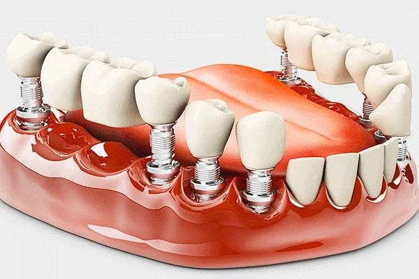 پروتز کردن دندان ها 1123658974