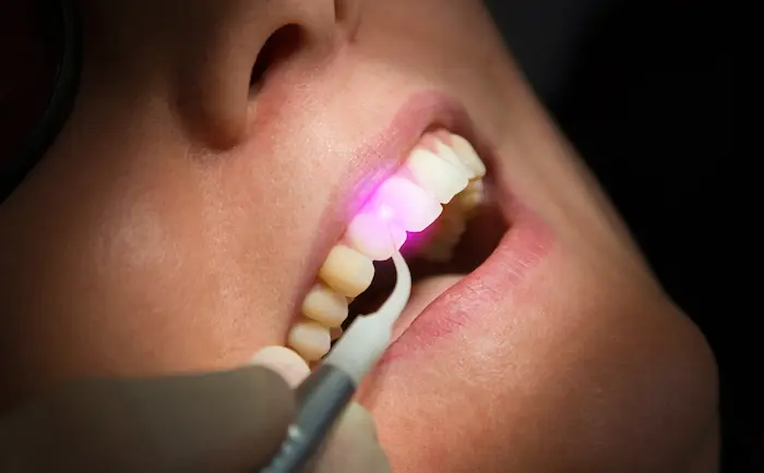 جرم گیری دندان با استفاده از لیزر توسط دکتر متخصص 528456