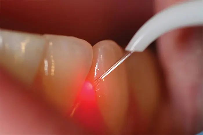جرم گیری دندان بیمار با استفاده از لیزر توسط دکتر دندان پزشک 5284456