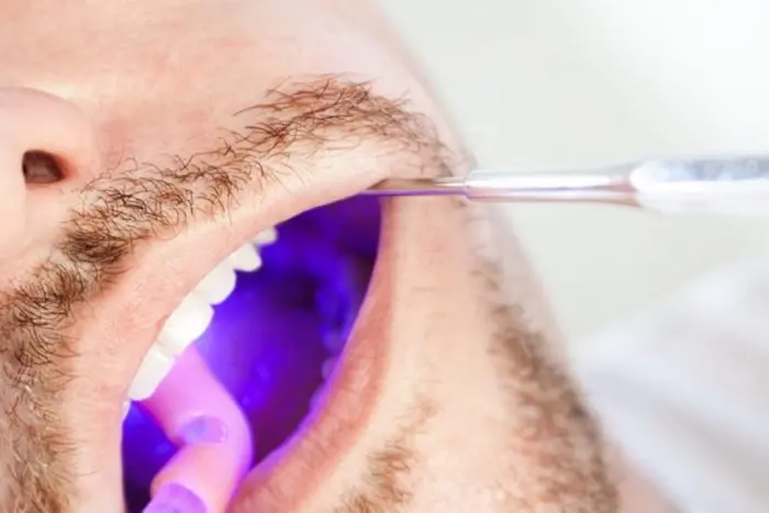 جرم گیری دندان بیمار با لیزر توسط دکتر متخصص 5284456
