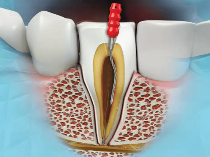 درمان عصب کشی دندان 52656526