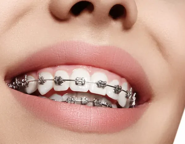 دندان های ارتودنسی شده یک خانم با مینی پلیت 25645